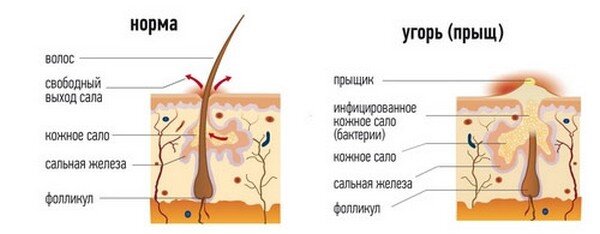 Черные точки схема. Акне кожа схема сальные железы. Строение угря на коже человека.