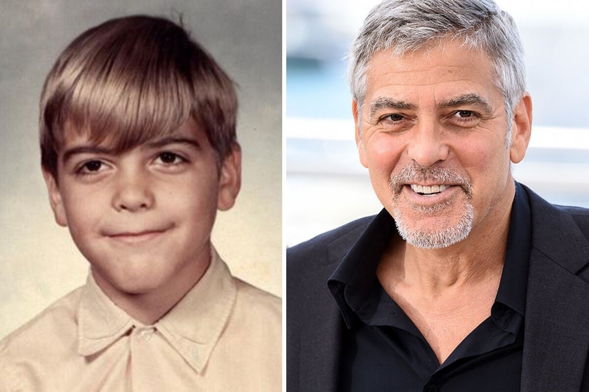 Джордж Клуни
Кличку Франкенштейн актер заработал из-за паралича, который внезапно поразил его в средней школе. Паралич Белла — генетическая болезнь, передавшаяся Клуни от отца. Около года Клуни ходил с парализованной половиной лица, у него не открывался левый глаз. «Это было худшее время в моей жизни, — жаловался актер в интервью The Mirror в 2003 году. — Меня высмеивали и дразнили, но это испытание сделало меня сильнее».