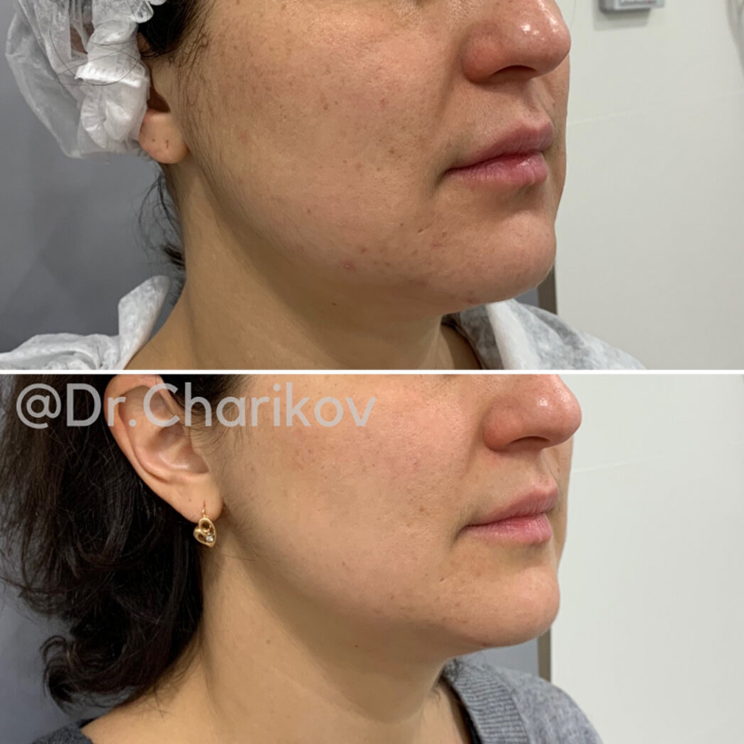 До-после, работа врача клиники Dr.ЭСТЕТИК на аппарате Inus ( микроигольчатый RF-лифтинг)