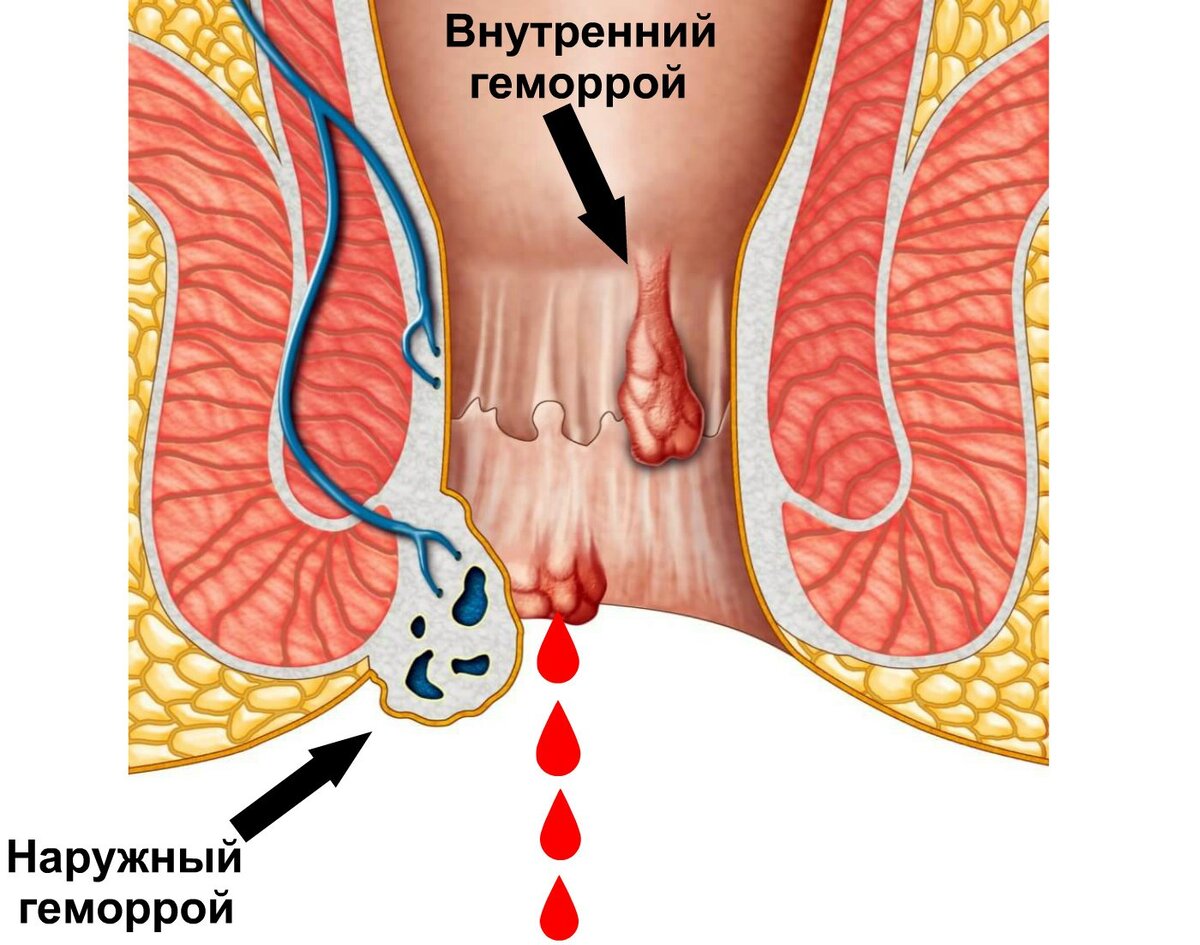 Геморрой у женщин