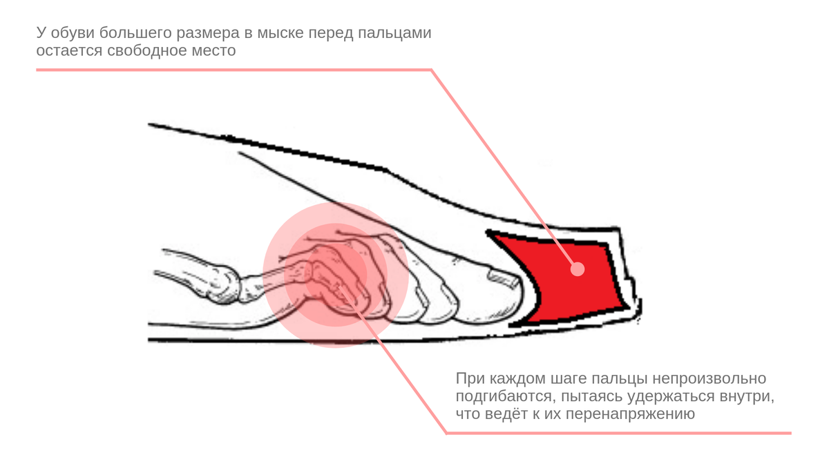 Обувь на вырост - в помойку! Почему опасно постоянно носить обувь которая вам велика?