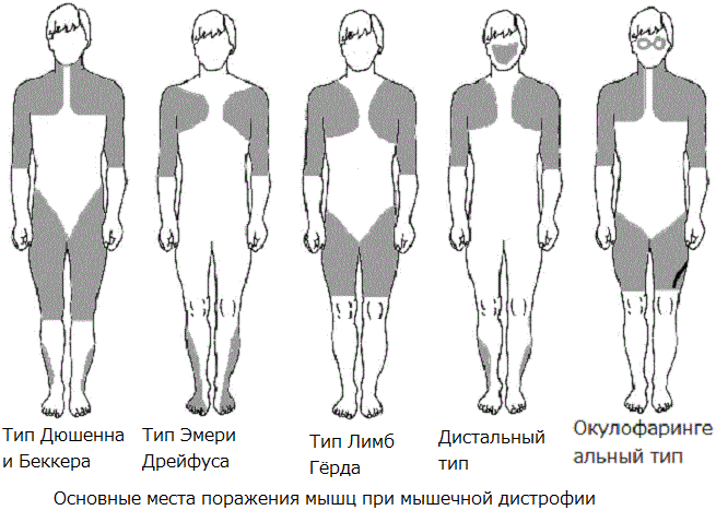 [caption id="attachment_1423" align="aligncenter" width="655"] Классификация по местам поражения[/caption]