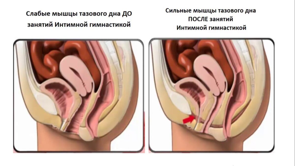 Ослабление мышц тазового дна: причины и лечение