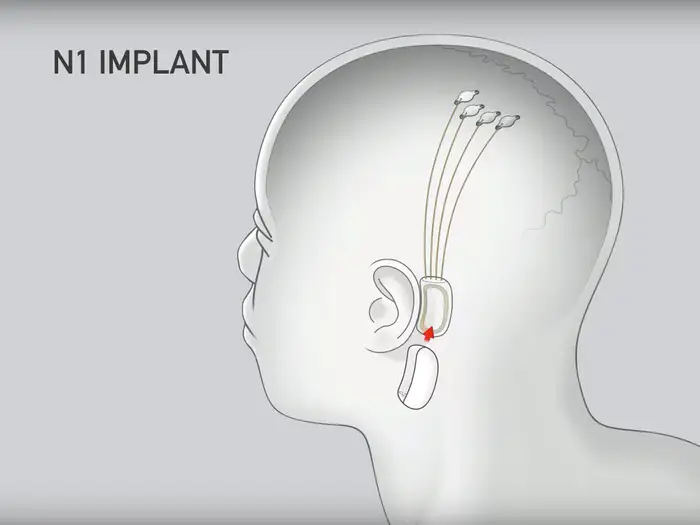 Иллюстрация чипа Neuralink в действии. Фото: Neuralink