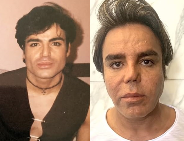  Слева - после первой пластической операции. Справа - перед пятой операцией. Фото: E!