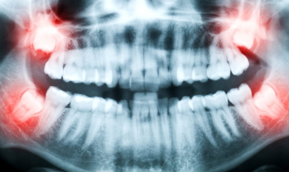  До 16 лет у большинства людей челюстной ряд считается сформированным. Но есть еще зуб мудрости у человека, который начинает свой рост с этого времени, доставляя массу неприятных ощущений.