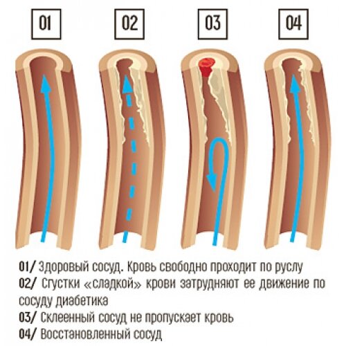 Сосуды при СД быстро изнашиваются