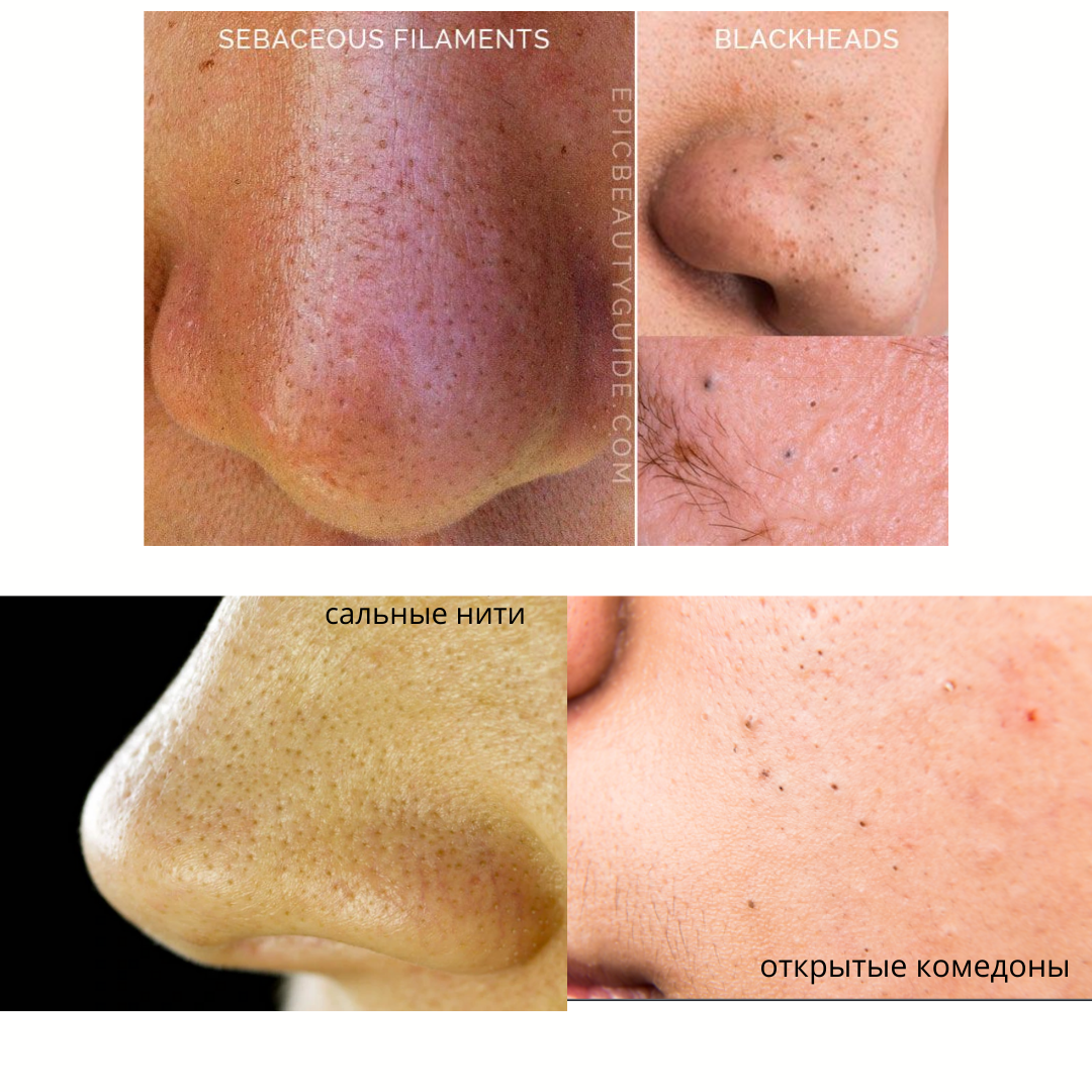 Сальные нити на лице как выглядят Маска для лица LanBeNa Nose Plants pore strips "Новый вид мазохизма у китайцев