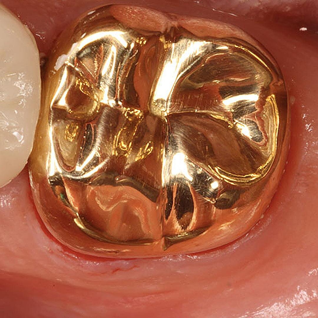 Коронка ходит на зубе. Золотые зубные коронки. Металлические зубные коронки.