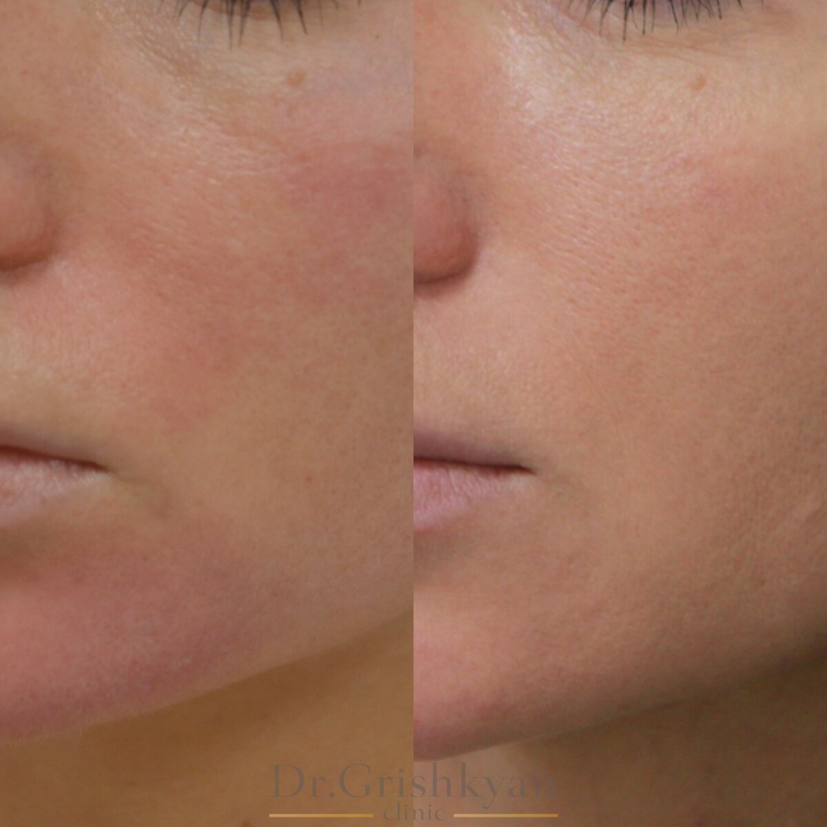 Результат биоревитализации фото до и после. Фото с сайта Д.Р. Гришкяна. Имеются противопоказания, требуется консультация специалиста