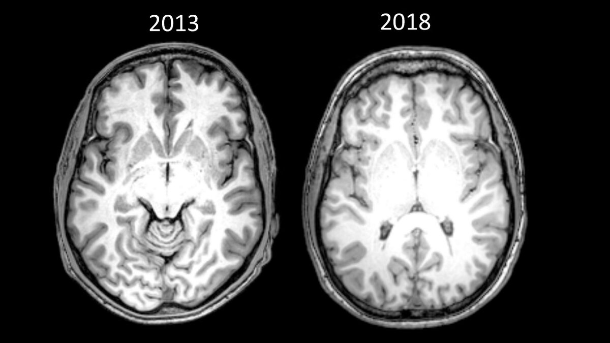 Источник: необработанные снимки моего мозга в 2013 и 2018 годах. Здесь приведён разрез, показывающий переднюю спайку, стандартное анатомическое представление, используемое для сравнения разные сканов мозга. Было сложно сделать прямое сравнение разрезов, потому что использовались разные МРТ, а снимки сделаны в различных разрешениях