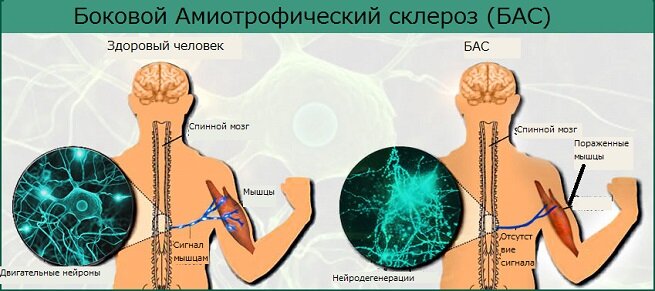 Боковой амиотрофический склероз (БАС): забота о пожилых с проблемами неврологии