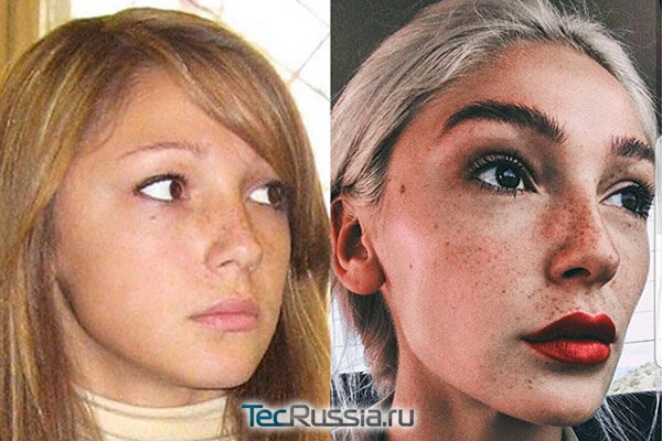 Ивлева до и после пластики фото