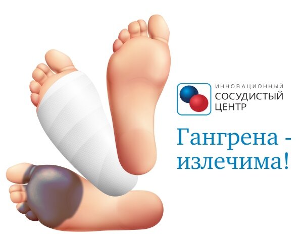 Лечение гангрены возможно без ампутации.