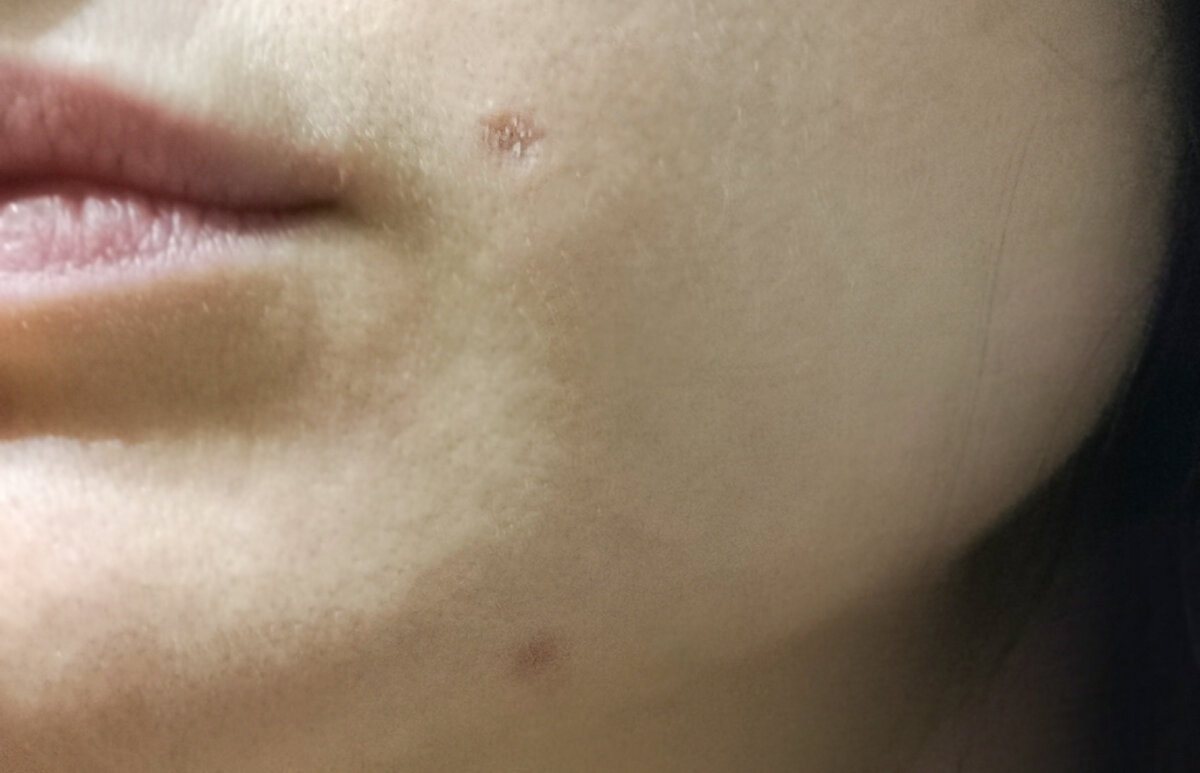 Ранки сразу после того, как отошли корочки. 