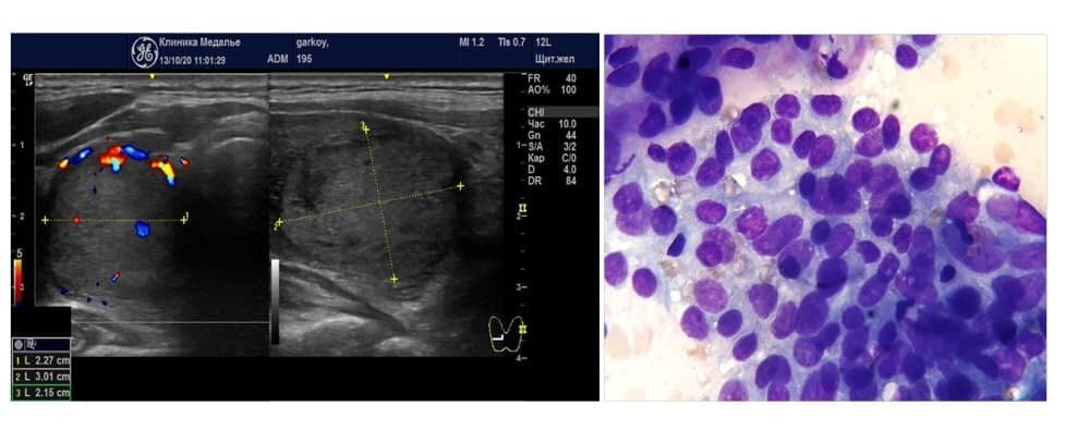 На второй фотографии – это средняя ситуация - видны и клетки с признаками секреторной активности, и клетки маленькие, неактивные, кровоток в узле умеренный. Это рабочий узел, средней степени активности.