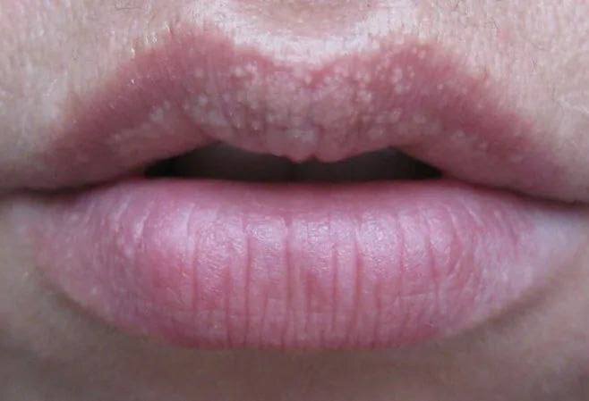 ГРАНУЛЫ ФОРДАЙСА | Зелья красоты | Дзен