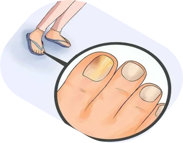 Это поражение грибковой инфекцией ногтевой пластины и окружающих ее структур.