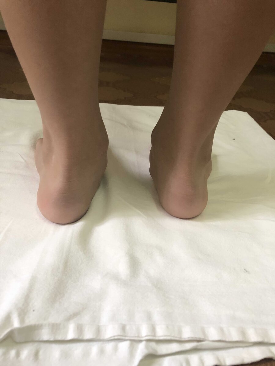 Лодыжка слева ниже чем справа. это приводит к функциональному укорочению нижней конечности!