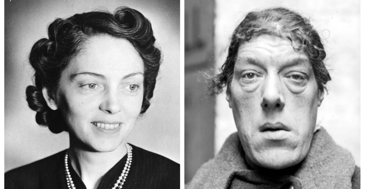 Мэри Энн Вебстер до и после болезни. Фото из интернета.