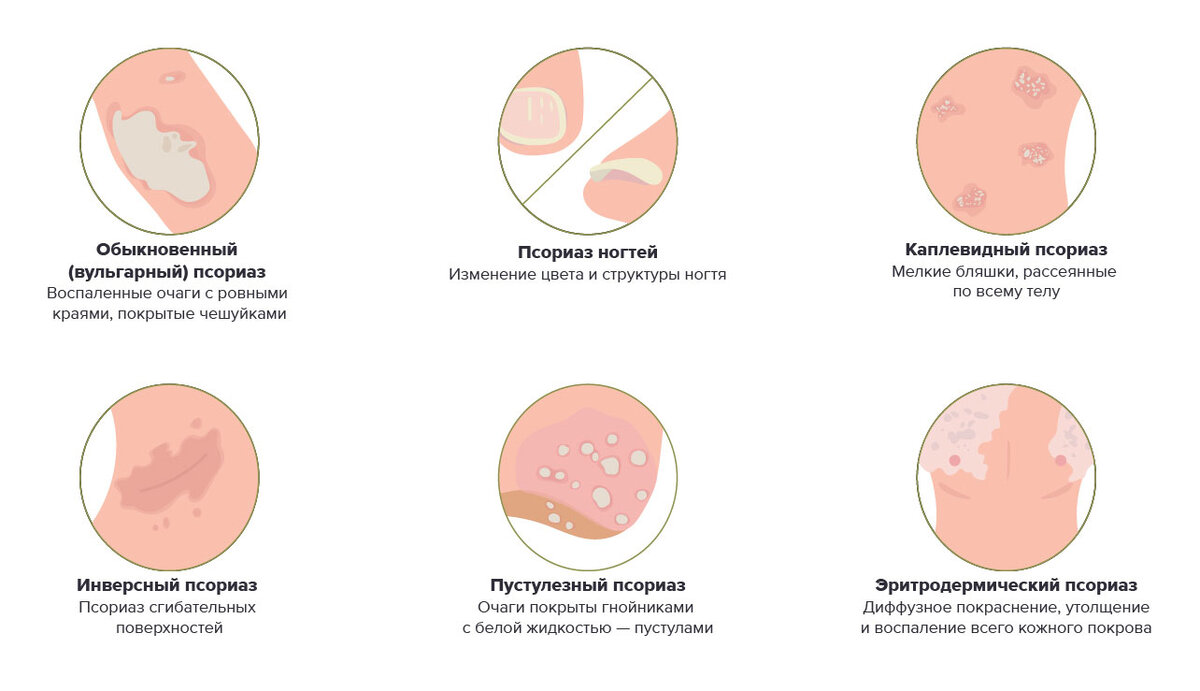 Генерализованный пустулезный псориаз. Что такое Генерализованный пустулезный псориаз?