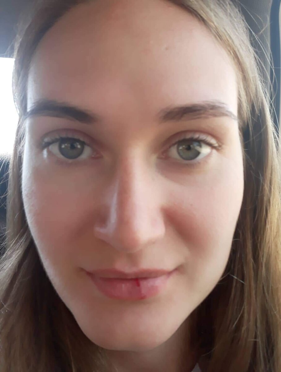 Разбитые губа и скула, синяка нет, но челюсть очень болела