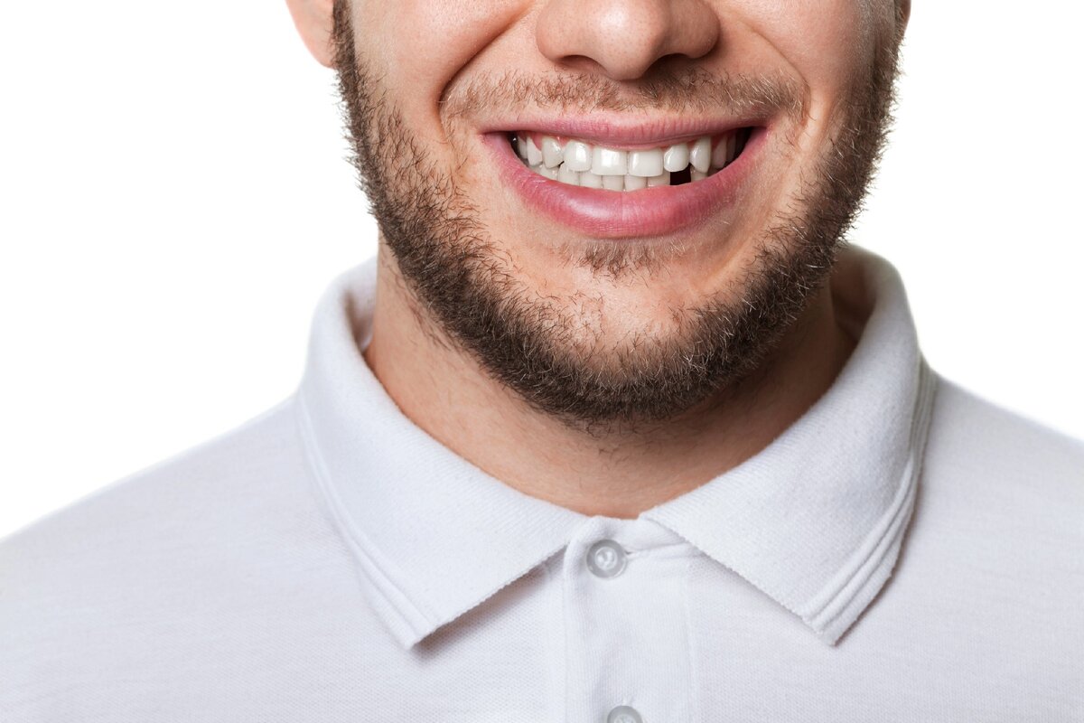 фото выбитых зубов