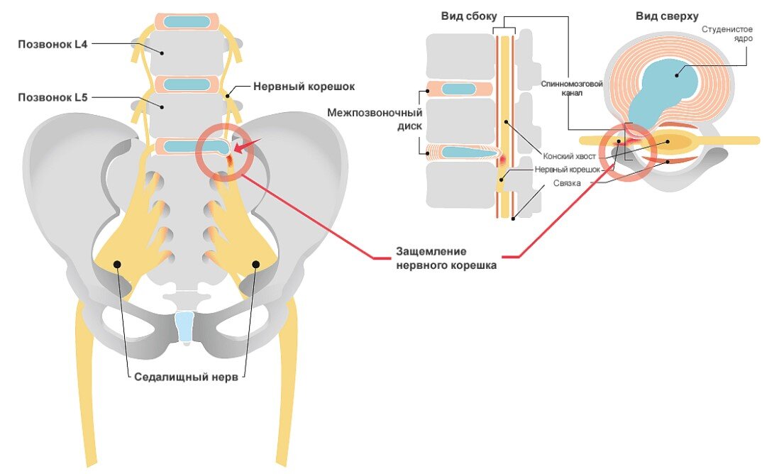 Ишиас – симптом, который может проявляться при различных заболеваниях пояснично-крестцового отдела