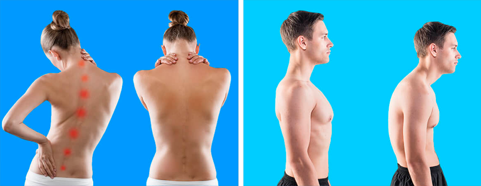 Ровная спина. Правильная спина. Спина здорового человека. Правильная ровная спина. Правильная поясница
