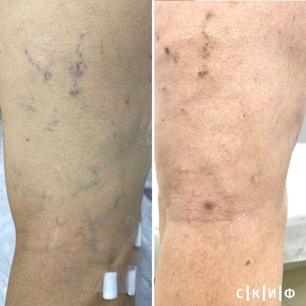 Результаты после проведения процедуры CLaCS