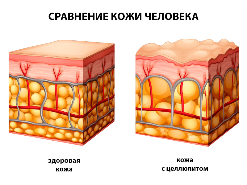 Воспаление жировой. Целлюлит воспаление ПЖК. Целлюлит воспаление подкожно-жировой клетчатки. Здоровая кожа и целлюлит. Строение кожи целлюлит.