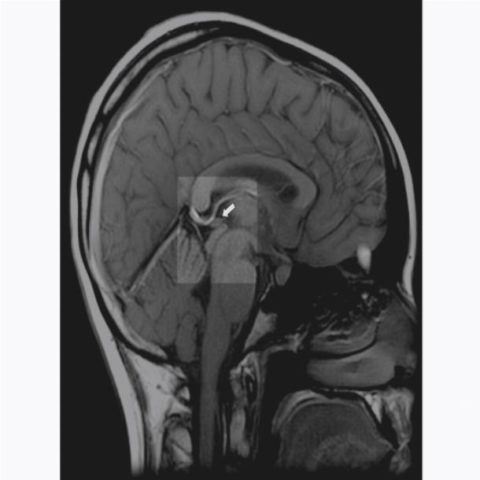 Киста сосудистого сплетения головного мозга у младенца