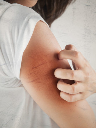 крапивница зуд