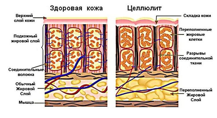 Излишек жира и проступает на поверхности кожи