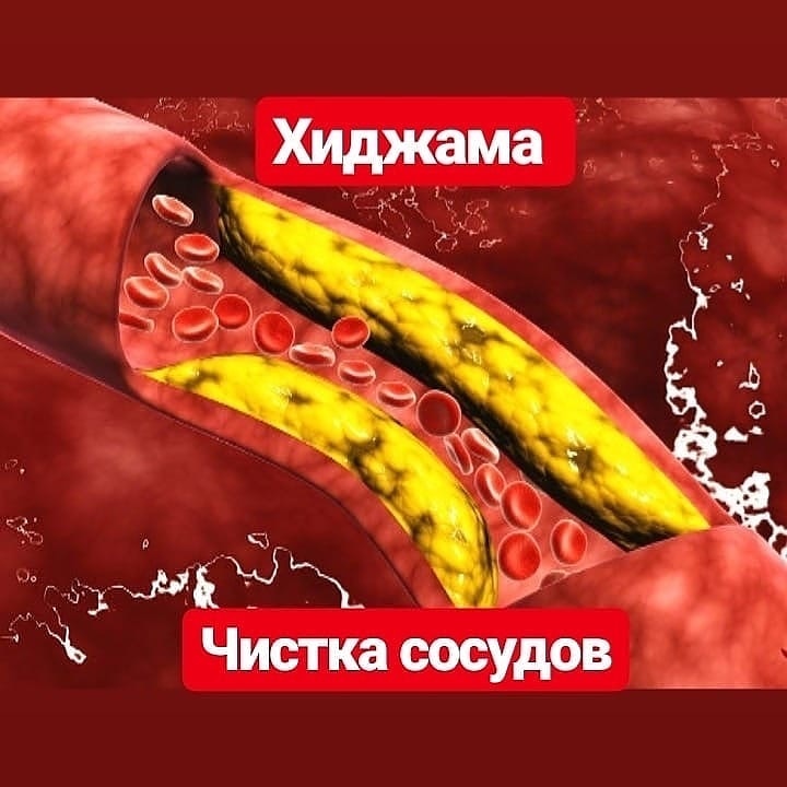 Польза хиджамы воротниковой зоны!✨ 
 
1. Снятие чувство усталости и напряжения мышц шеи и плечевого пояса. 
 
2. Улучшение микроциркуляции крови в шейно-воротниковой зоне, что помогает уменьшить болевой синдром в случае наличия отека (это то, что называется «продуло мышцу»), или скопления молочной кислоты. 
 
3. Благодаря тому, что мышцы шеи расслабляются, улучшается кровоснабжение головного мозга. Именно этот эффект помогает устранить головную боль и нормализовать сон. 
 
4. Идёт воздействие на рефлексогенные зоны, расположенные в этой области, что приводит к улучшению работы внутренних органов. 
 
5. Улучшается общее самочувствие, повышается жизненный тонус и трудоспособность. 
 
Конечно, эффективность хиджамы напрямую зависит от профессионализма человека, который его выполняет, поэтому к выбору хаджама нужно подходить ответственно. 