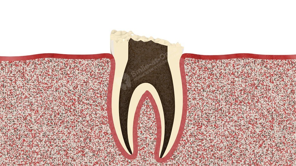 Удаление корня зуба - показания, методы и этапы, осложнения