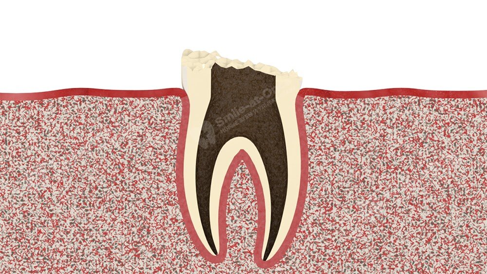Восстановление сильно разрушенного зуба