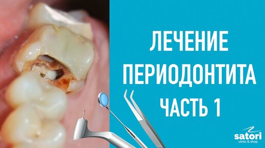 периодонтит лечение цена
