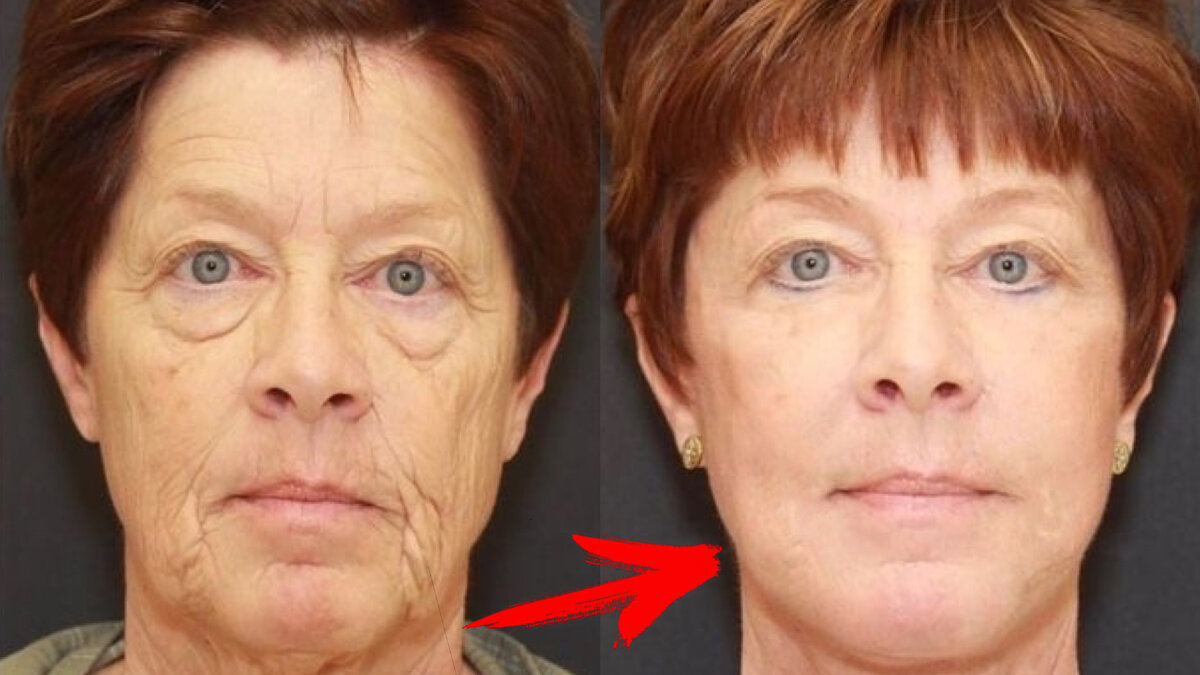 #как убрать морщины #уход за лицом #антивозрастной уход #лифтинг лица #маска от морщин 