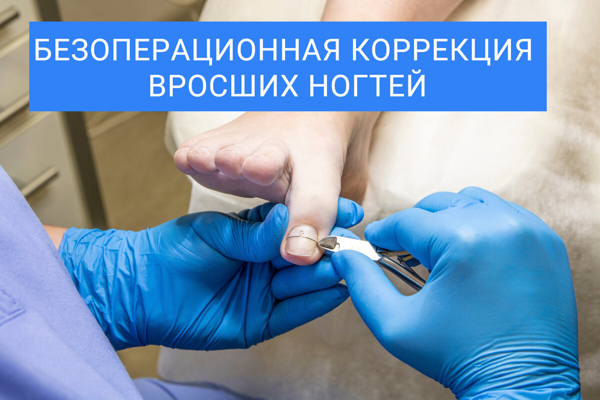 На фото представлен фрагмент установки скобы 3ТО