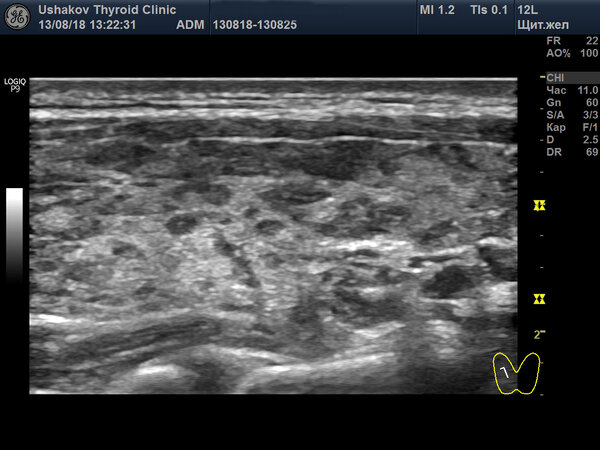 УЗИ щитовидной железы от 13.08.2018