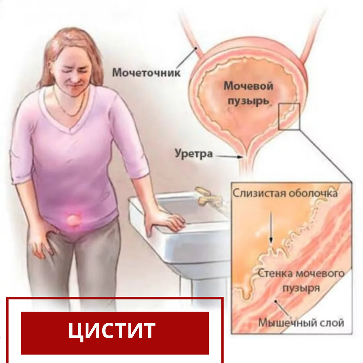 Молочница и цистит одновременно. Интерстициальный цистит. Цистит у женщин.
