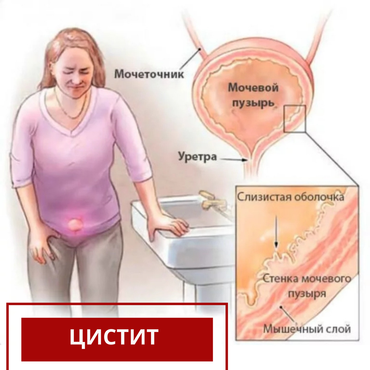 Цистит уретрит лечение. Цистит у женщин. Мочевойпузыоь пр цистите.