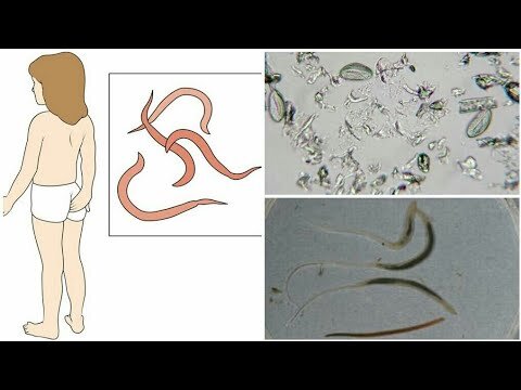 Острицы у женщин: лечение паразитов во влагалище