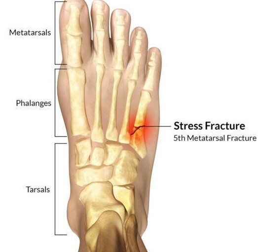 Стресс-перелом 5 плюсневой кости