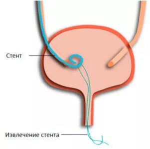 Болезни мочевыделительной системы могут стать причиной развития патологий, которые препятствуют нормальному выделению мочи из системы организма. Врожденные аномалии развития и приобретенные патологии часто приводят к сужению просвета в мочеточнике, иногда до полного его закрытия. Жидкость, которую вырабатывают почки, отходит по мочеточникам в мочевой пузырь и выводится через мочеиспускательный канал. Мочеточники эластичны и могут расширяться в диаметре от 0,3 до 1,0 см. Ряд негативных факторов могут нарушить работу мочеточников сужая просвет или приводя к его закупориванию и нарушению проходимости жидкости по каналам. В результате моча в почках задерживается и возникает состояние, опасное для жизни и здоровья человека. В качестве лечения врачи используют процедуру введения стенда в мочевой канал для улучшения оттока жидкости.