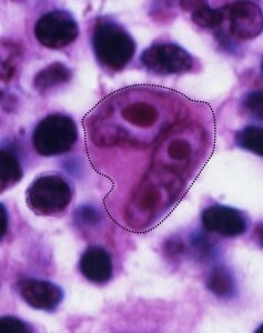 Под микроскопом видна гигантская клетка Рида-Штернберга — признак лимфомы Ходжкина