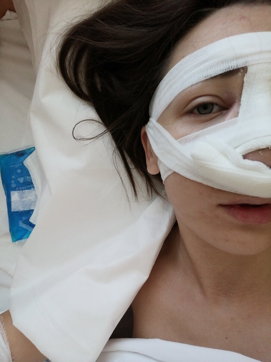 После операции. Левый глаз уже заплыл