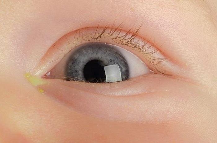 Конъюнктивит глаз - лечение у детей