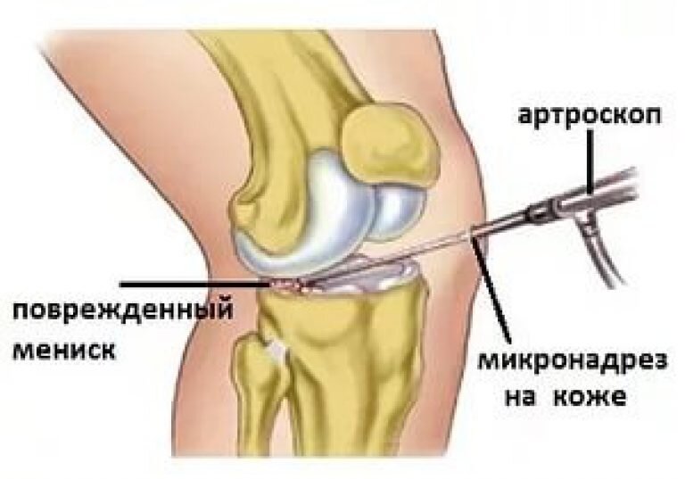 Почему болит мениск. Повреждение мениска коленного сустава. Разрыв мениска коленного симптомы. Разрыв мениска коленного сустава. Разрыв мениска коленного сустава симптомы.